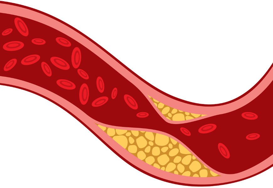 Na aterosclerose, a formação de placas constituídas por células inflamatórias, lipídios e elementos fibrosos causa a obstrução das artérias.