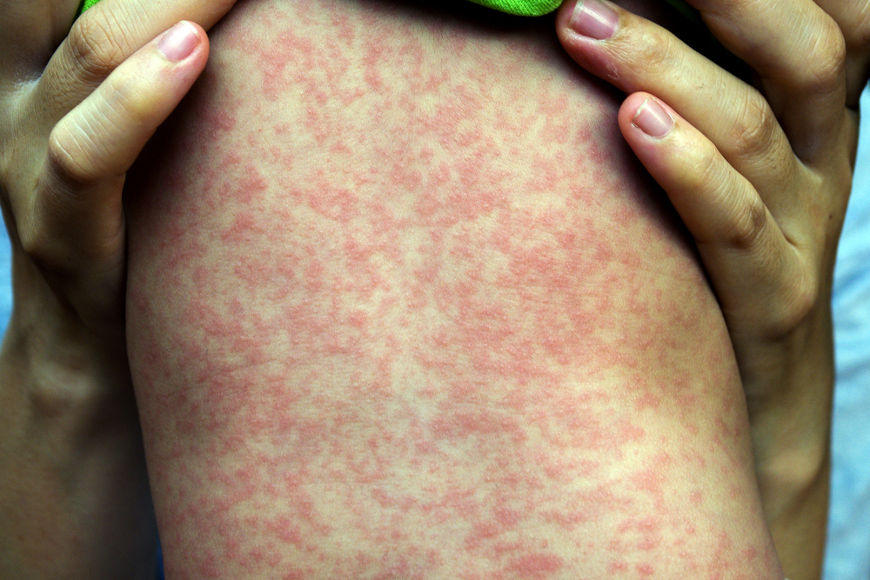 Um dos principais sintomas do sarampo Ã© o surgimento de exantema (erupÃ§Ãµes cutÃ¢neas) avermelhado por todo corpo.