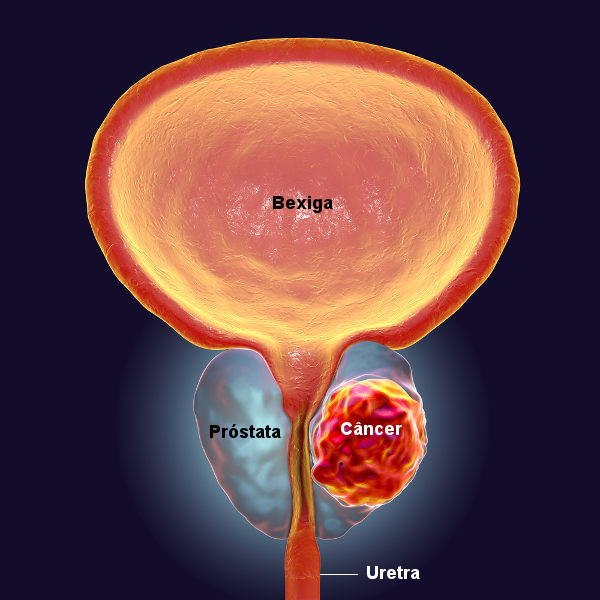 El cáncer de próstata afecta la próstata, una glándula ubicada debajo de la vejiga.