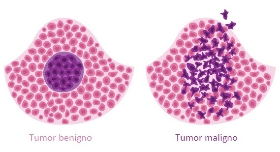 Nas neoplasias malignas, as cÃ©lulas podem invadir tecidos adjacentes.