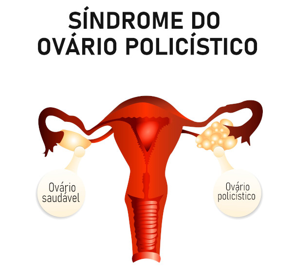 El síndrome de ovario poliquístico afecta hasta al 10% de las mujeres en edad reproductiva.