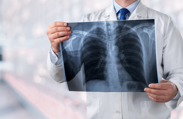 Exames de imagem, como a radiografia pulmonar, sÃ£o essenciais para a realizaÃ§Ã£o do diagnÃ³stico de pneumonia.