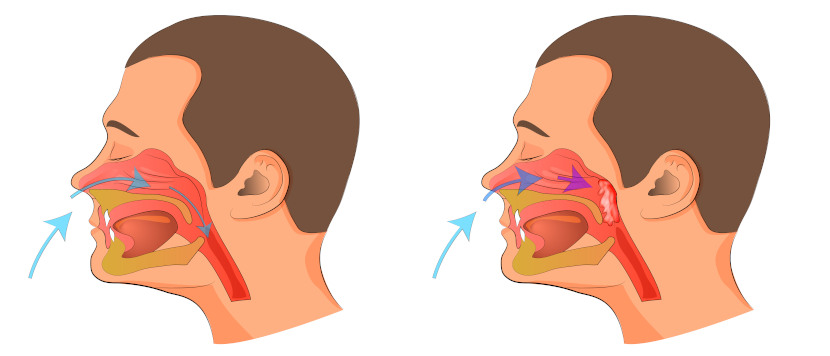 Quando a tonsila faringiana estÃ¡ aumentada, hÃ¡ dificuldade para respirar.