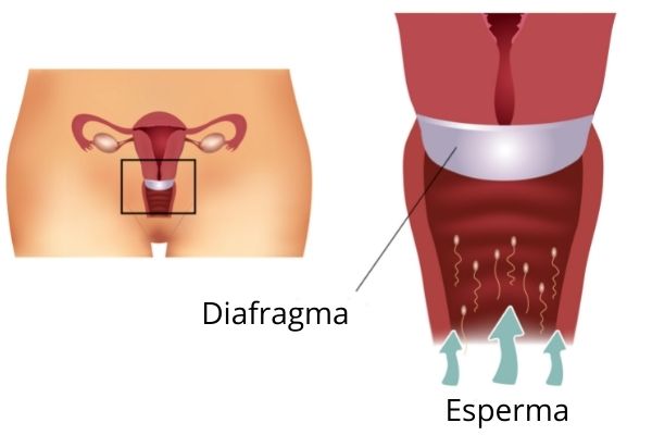 IlustraÃ§Ã£o de como o diafragma, mÃ©todo contraceptivo, impede a passagem do esperma.