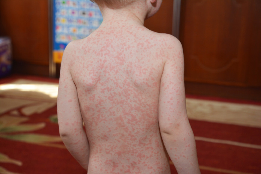 Manchas na pele em crianÃ§a causadas pela mononucleose infecciosa