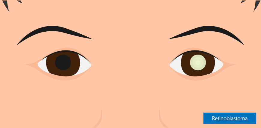 IlustraÃ§Ã£o dos olhos de uma crianÃ§a com leucocoria em um dos olhos, com indicaÃ§Ã£o de retinoblastoma na lateral da imagem.