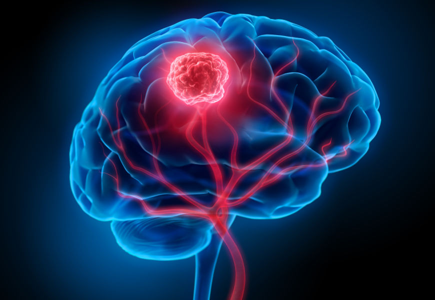  IlustraÃ§Ã£o em 3D de um tumor, destacado em vermelho, em um cÃ©rebro.