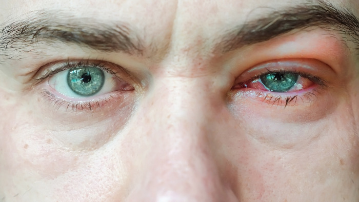 Olhos humanos masculinos, e um deles com conjuntivite