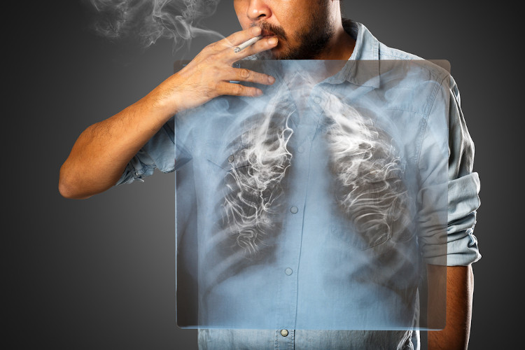 Homem fumando um cigarro com placa na sua frente simulando um raio-X dos pulmÃµes durante o ato
