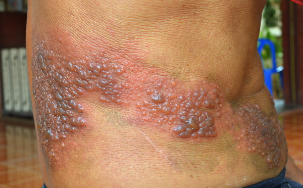 Pele humana com vesículas características do herpes-zóster