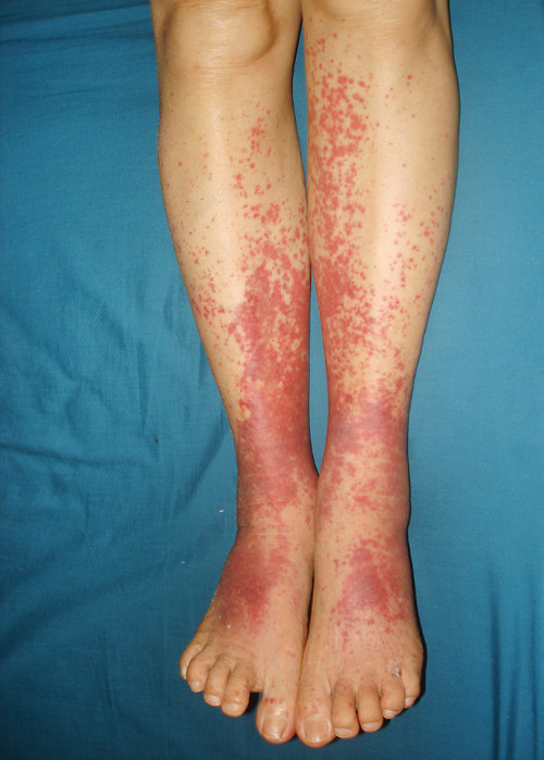 Manchas nas pernas de uma pessoa com vasculite (inflamaÃ§Ã£o dos vasos sanguÃ­neos).