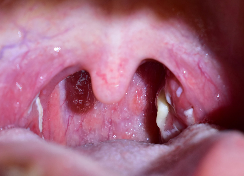 Vista de uma garganta com pontos purulentos nas amÃ­gdalas, um sintoma de amigdalite.