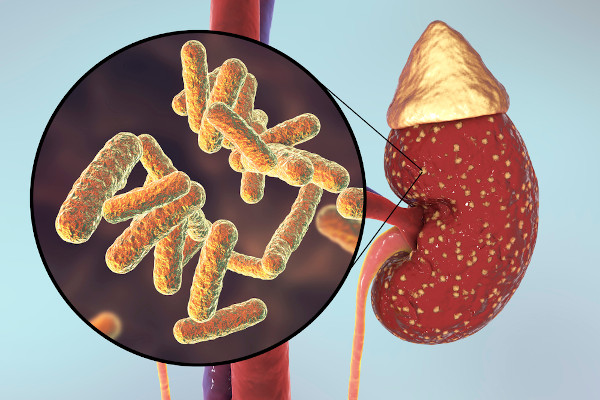 Ilustração de bactérias em um rim humano, uma das causas da pielonefrite.