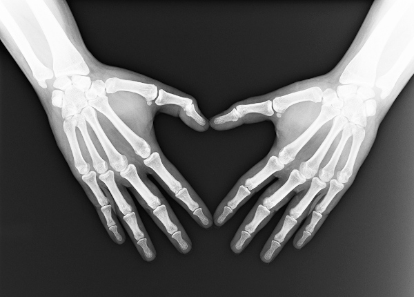 Radiografia em que podem ser vistos os ossos de duas mãos.