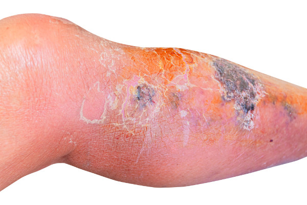Lesões da erisipela na pele de uma perna humana.