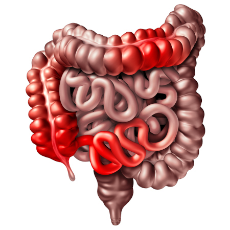 Ilustração de parte do trato gastrointestinal, com as regiões que podem ser afetadas pela doença de Crohn em vermelho.