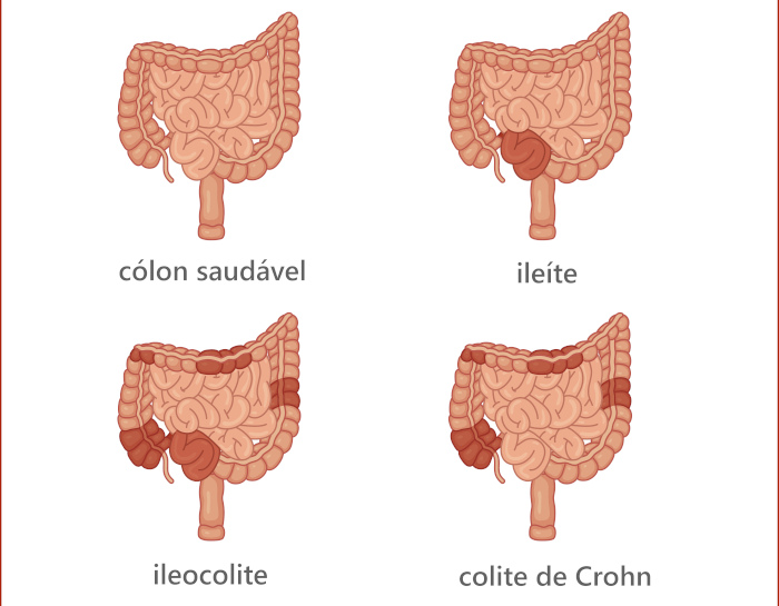 Exemplos de regiÃµes do trato gastrointestinal que podem ser afetadas pela doenÃ§a de Crohn.