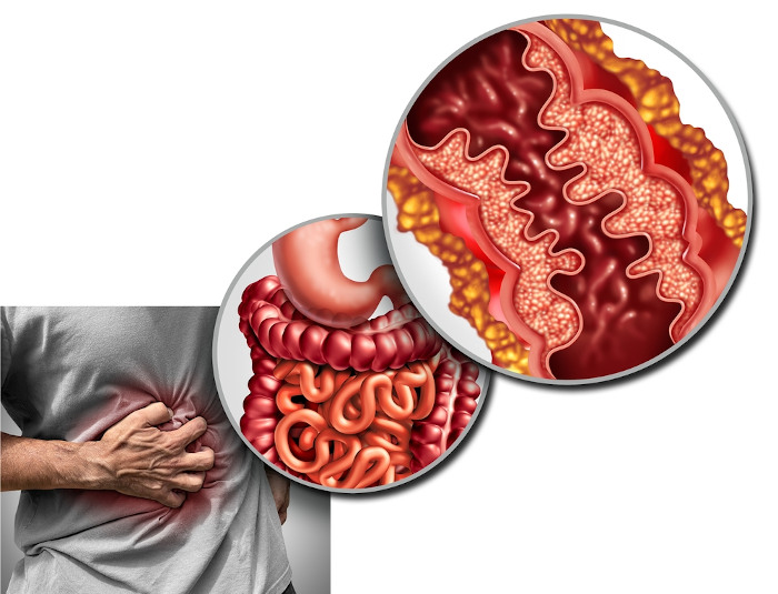  IlustraÃ§Ã£o indicando um dos principais sintomas da doenÃ§a de Crohn.