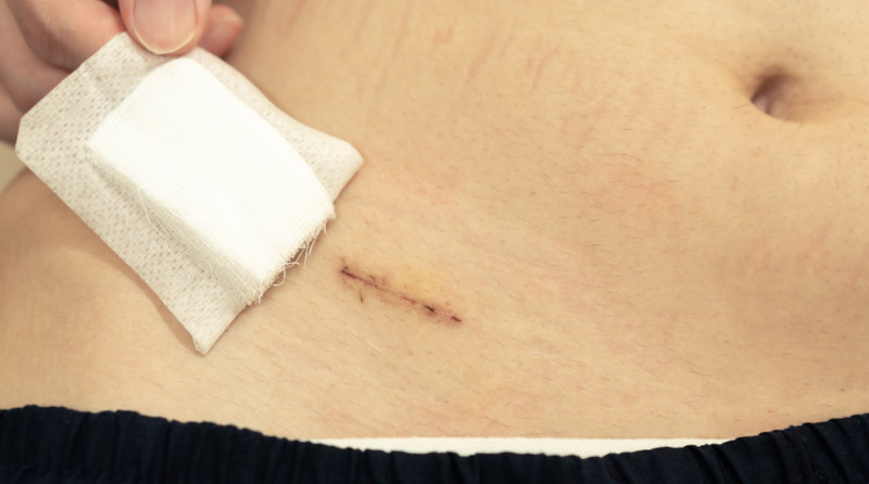 Cicatriz decorrente da cirurgia da retirada do apÃªndice.