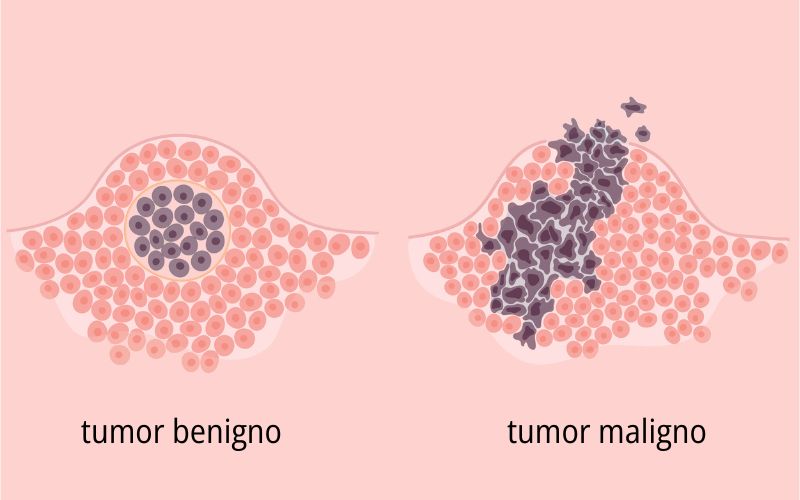 CÃ©lulas em tumores maligno e benigno, resultante de erros na mitose.