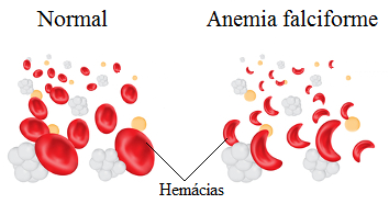 Anemia falciforme