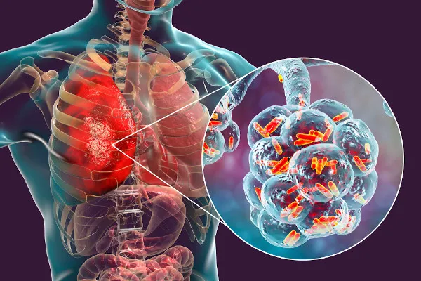 Pneumonia