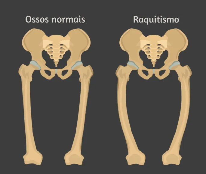 Raquitismo