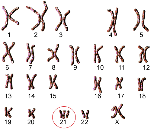Na sÃ­ndrome de Down, ocorre uma alteraÃ§Ã£o no cromossomo 21, que Ã© encontrado em triplicata