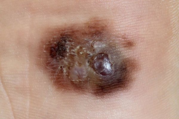 IMAGEM FORTE: O melanoma atinge os melanÃ³citos e surge como pintas de cor escura.