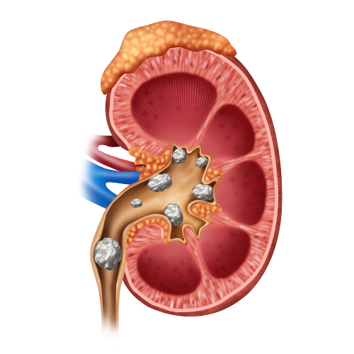 A litíase renal é a formação de cálculos urinários e pode provocar cólica renal e presença de sangue na urina