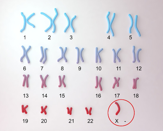 A síndrome de Turner é causada pela ausência de um cromossomo X no organismo