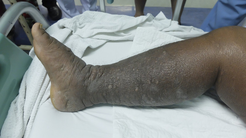 Alguns dos sintomas da filariose são a hipertrofia e inchaço, principalmente das pernas e pés