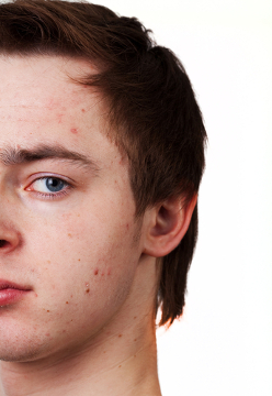 Apesar do que muitos pensam, a acne não está relacionada com sujeira