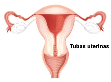 Na laqueadura ocorre a obstrução das tubas uterinas