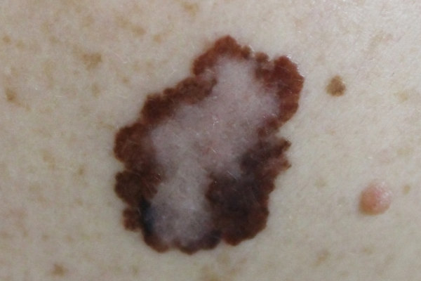 O câncer de pele pode surgir como manchas na pele.