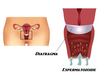 Diafragma O diafragma é um método contraceptivo que deve ser colocado na região do colo do útero
