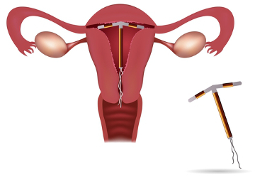 O DIU é um artefato que é colocado no interior da cavidade uterina
