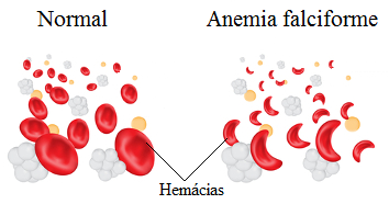 Observe o formato de foice das hemácias na anemia falciforme